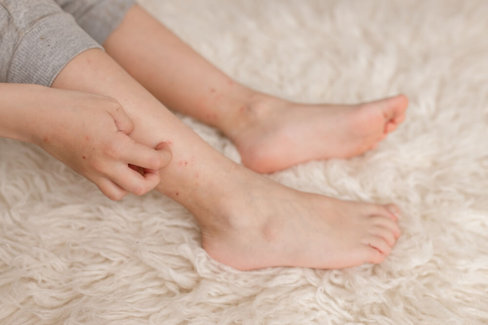 Close-up of a person sitting on a cream-colored rug, scratching their lower leg with flea bites, which has small red spots. The person is wearing gray pants.