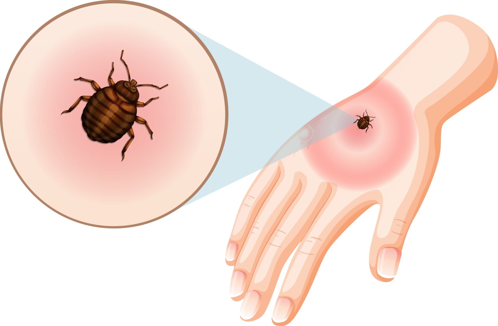 Illustration of a bedbug biting a human hand, causing a red, swollen area. The image includes an enlarged circle for detailed bed bug identification, highlighting its intricate features and bite symptoms.