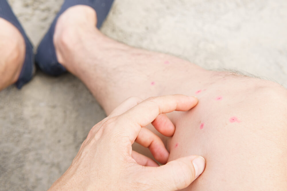 A person's leg, marked by several red welts possibly indicating flea bites, is shown. A hand gently touches one of the welts, seemingly to identify flea bites. The individual wears dark shoes without visible socks against a light gray surface.