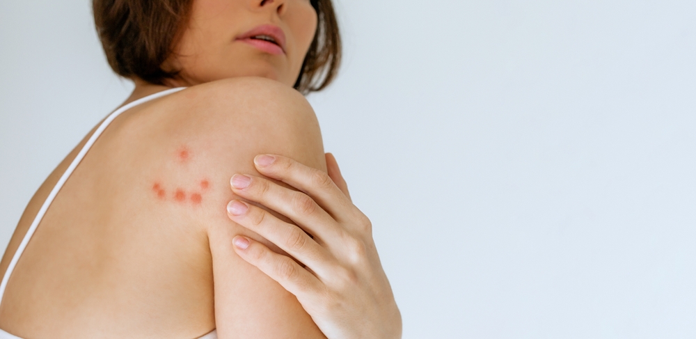 A person with short brown hair looks over their shoulder, revealing red circular marks on the skin—potential symptoms of bed bug bites. They are wearing a white top, and their hand rests gently on the marked shoulder against a plain white background.